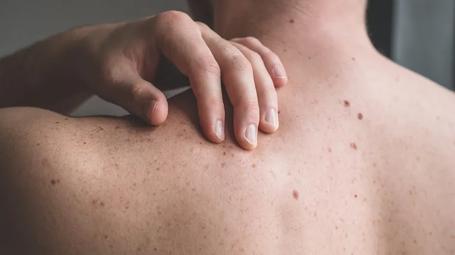 Da ngứa sau khi tắm do nguồn nước